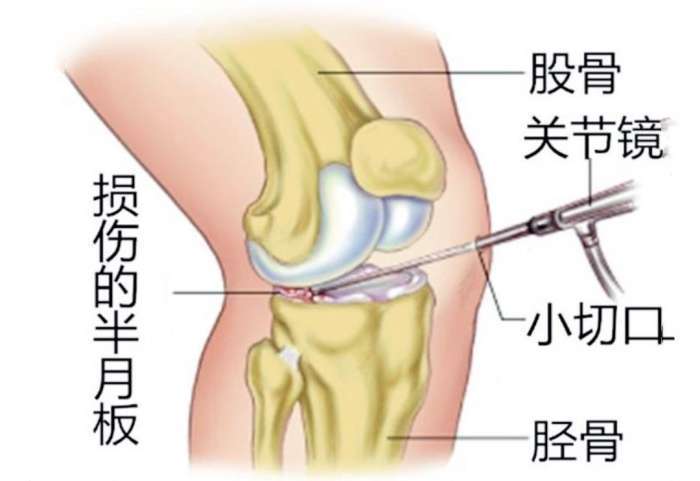 半月板再生术最新进展，重塑关节健康的希望之光揭秘